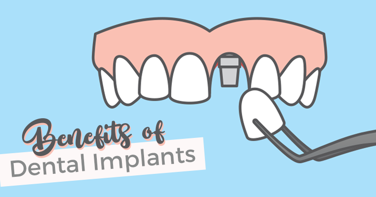 benefits of dental implants