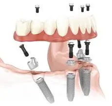 Nobel Biocare AII-on-4 Treatment Concept