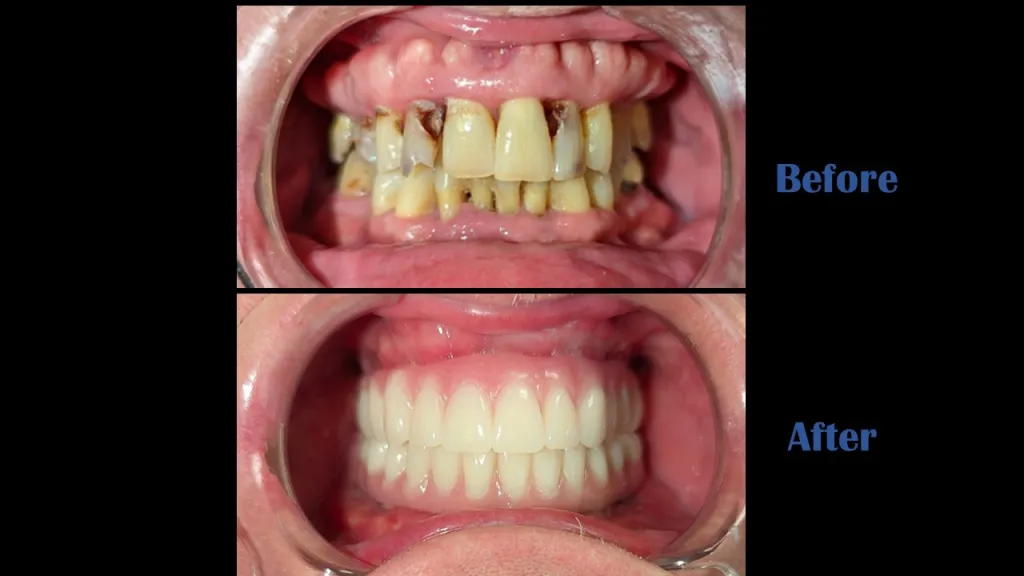 ALL-ON-4® TREATMENT CONCEPT: Condition of patients teeth before and after