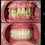 ALL-ON-4® TREATMENT CONCEPT: Condition of patients teeth before and after