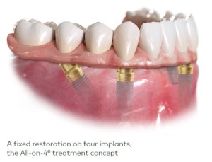 Teeth Denture