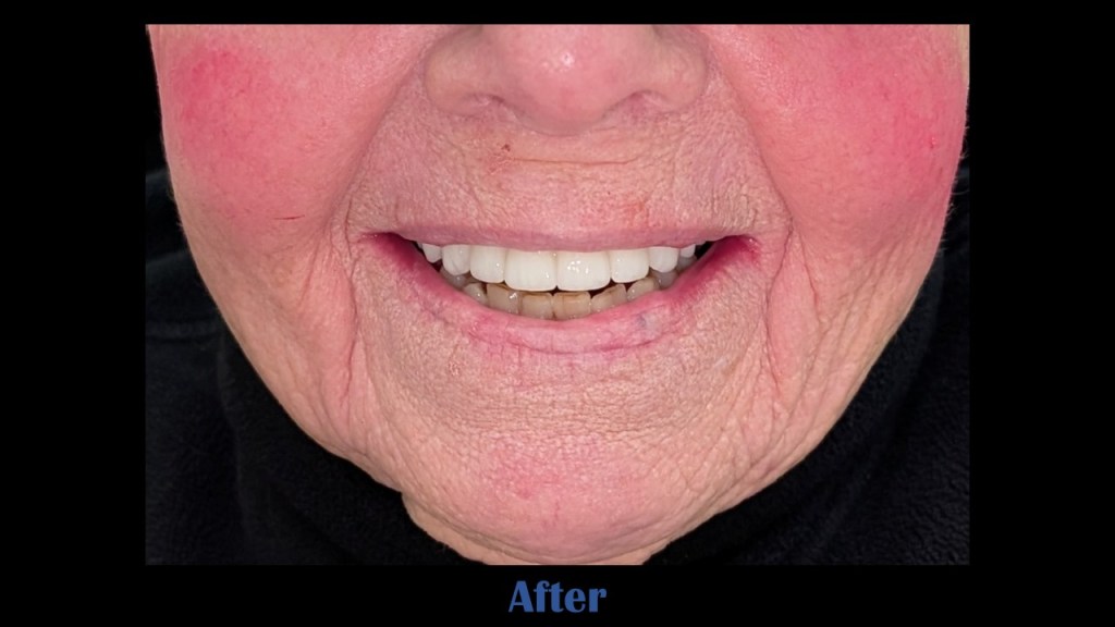 image of patient after receiving all-on-4 dental implants