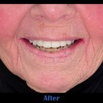 image of patient after receiving all-on-4 dental implants