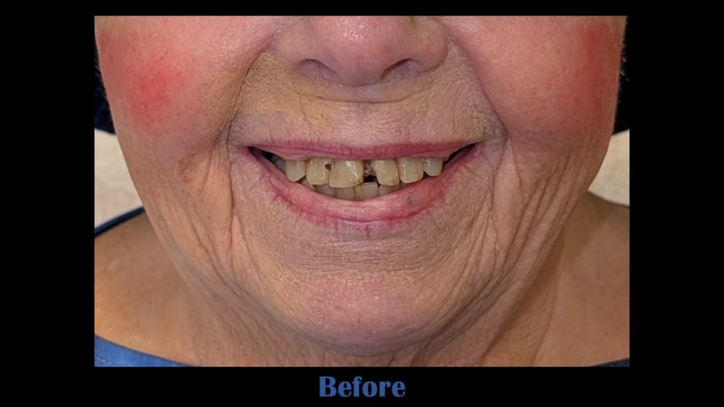 image of patient before receiving all-on-4 dental implants