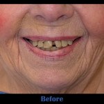 image of patient before receiving all-on-4 dental implants